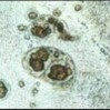 Typical granuloma seen in a wet mount of stomach tissue from an African cichlid with Cryptobia iubilans infection. The section is unstained and is examined with a light microscope (100x)