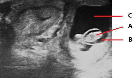 Imagen ultrasonográfica del cuerpo uterino de una vaca con una gestación de 60 días, se visualiza al feto (A) dentro de la vesícula amniótica, (B) y fluido alantocoriónico, (C) rodeándolo. Crédito: UF/IFAS NFREC Repro Lab (2022).